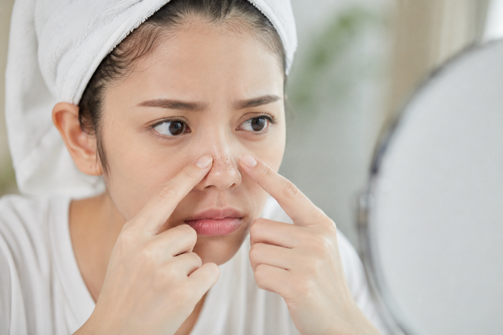 Cara Menghilangkan Komedo di Hidung dengan Aman