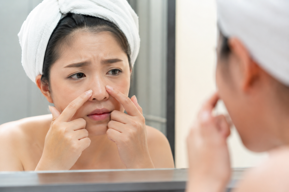 Cara Menghilangkan Komedo di Hidung dengan Aman dan Efektif, Ini Tips dari Ahli Kulit
