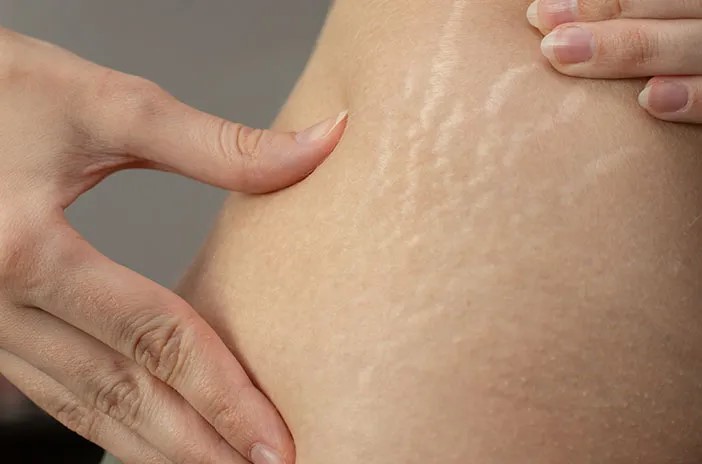 Stretch Mark Bikin Ga Percaya Diri? Kenali Cara Menguranginya