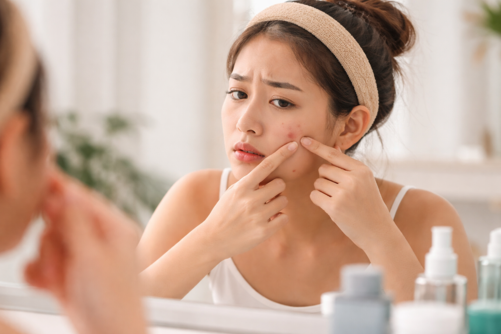 Ini Beragam Kebiasaan Sehari-hari yang Memicu Munculnya Jerawat