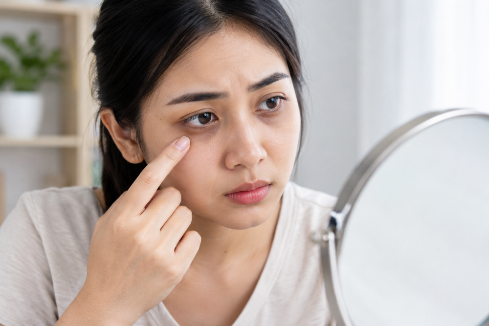 Mata Hitam Bukan Hanya karena Kurang Tidur, Ini 7 Penyebab yang Perlu Diketahui